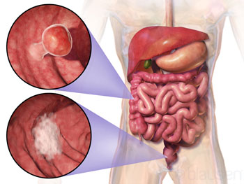 ColorectalCancer